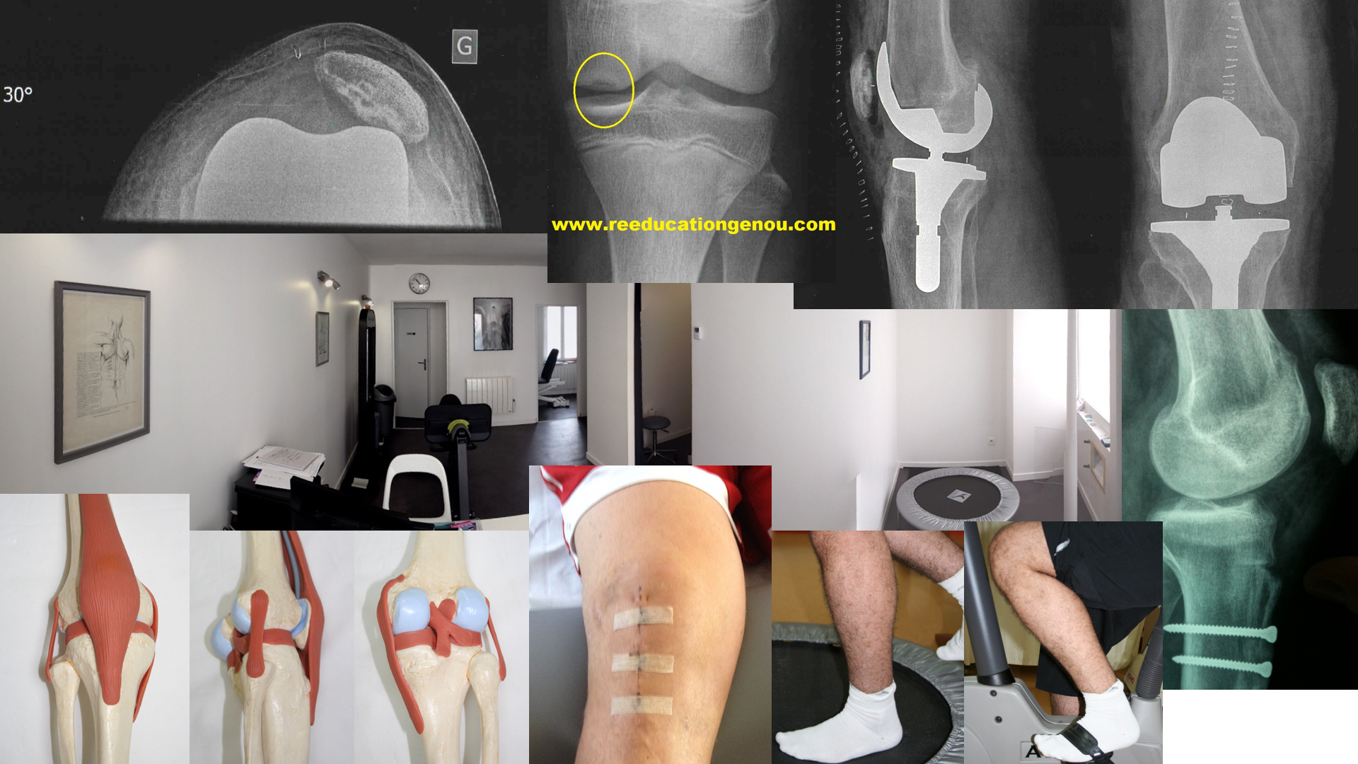 ligament lateral interior interior al articulației genunchiului